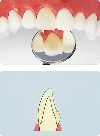 ハイグレードタイプ オールセラミック