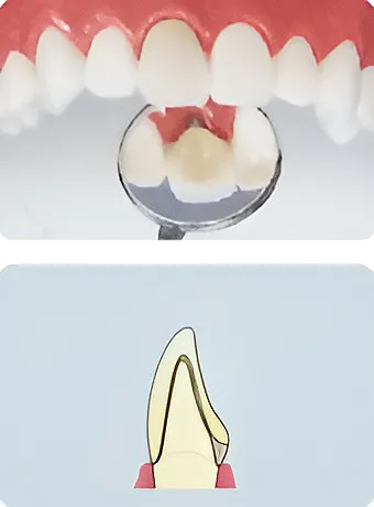 スタンダードタイプ メタルボンド