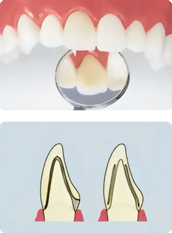 エコノミータイプ　ハイブリッドセラミック