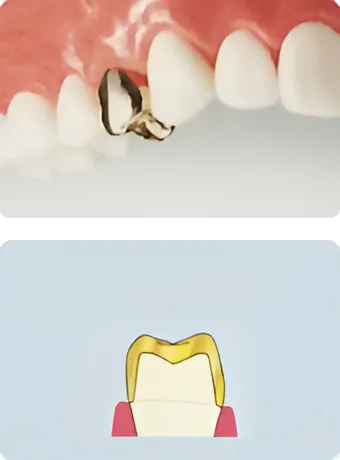 ハイグレードタイプ オールセラミック