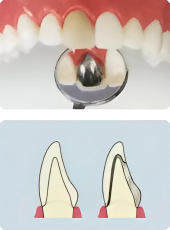 ハイグレードタイプ オールセラミック