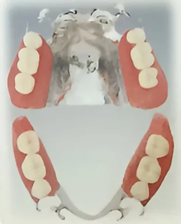 スタンダードタイプ 超硬質コバルトクローム合金