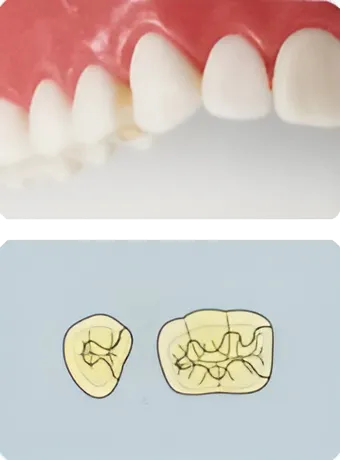 ハイグレードタイプ オールセラミック