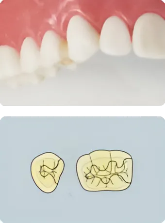 スタンダードタイプ ハイブリッドセラミック