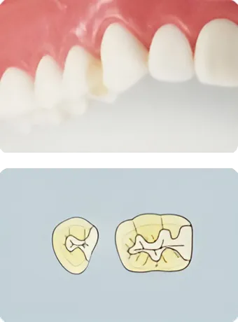 コンポジットレジン