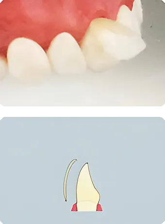 ハイグレードタイプ オールセラミックベニヤ